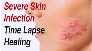Severe Facial Skin Infection Healing Time Lapse: Impetigo to Cellulitis to Resolution (0 to 30 days)