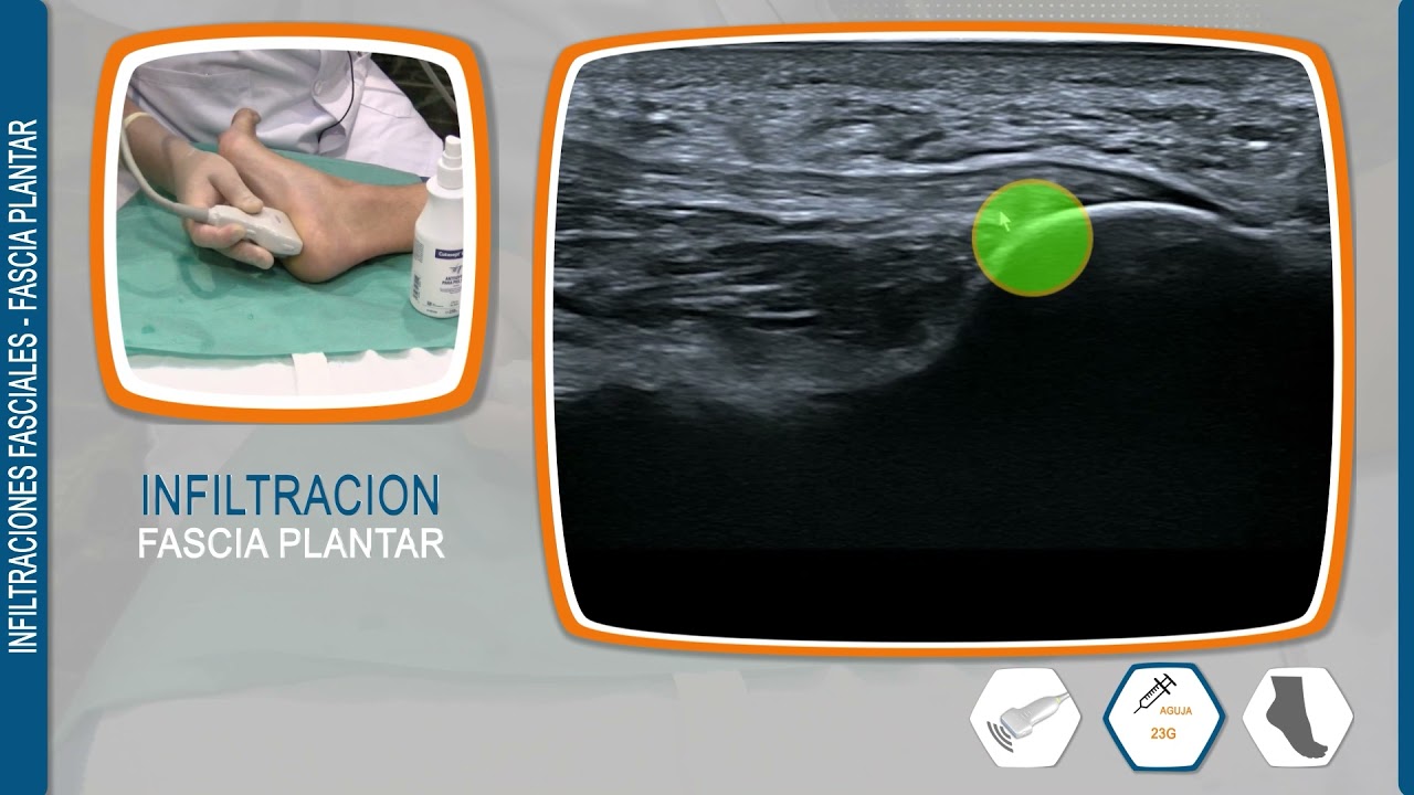 INFILTRACIONES FASCIALES   FASCIA PLANTAR