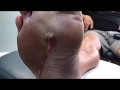 Pus draining from huge foot abscess abscess in foot w infection