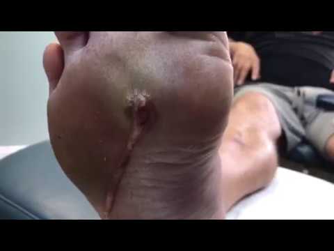 Pus Draining From Huge Foot Abscess Abscess In Foot W Infection