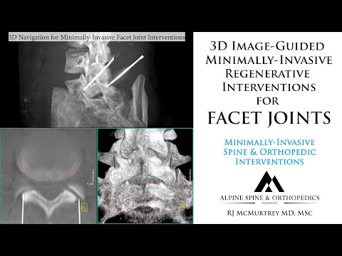 Facet Joint Injections with 3D Guidance