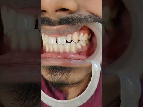 Transform your smile♥️Let's