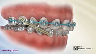 Canine Substitution Explained | Treating Missing Upper Lateral Incisors