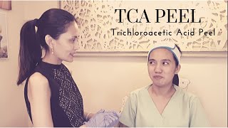 TCA Peel for Acne Scars (Trichloroacetic Acid Peel)