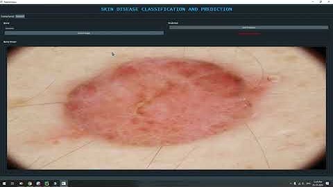 SKIN DISEASE CLASSIFICATION PYTORCH GUI | Machine Learning | Deep Learning | Python Project