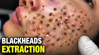 Blackheads Removal and Whitehead Removal for Deep Pore | ASMR | Remove Blackhead