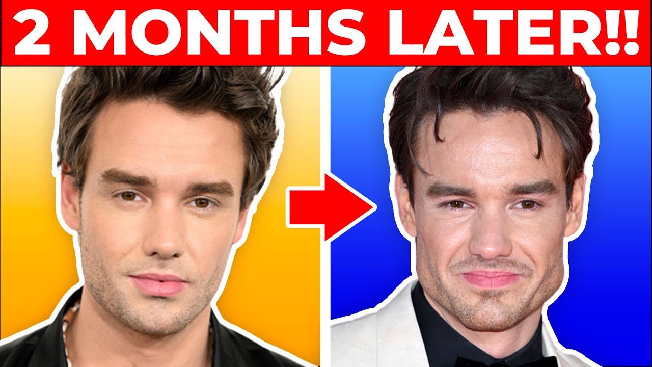 LIAM PAYNE'S Plastic Surgery Transformation: Cosmetic Surgeon Reacts!