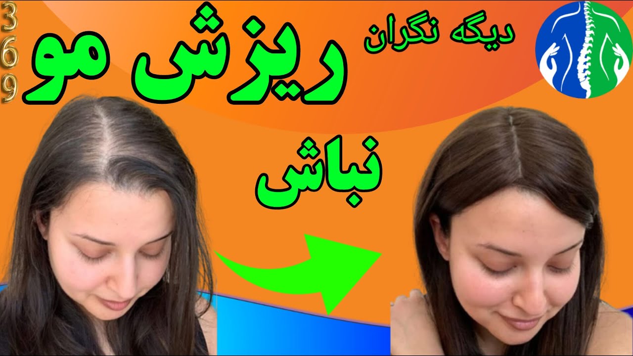 برای ریزش مو چی خوبه