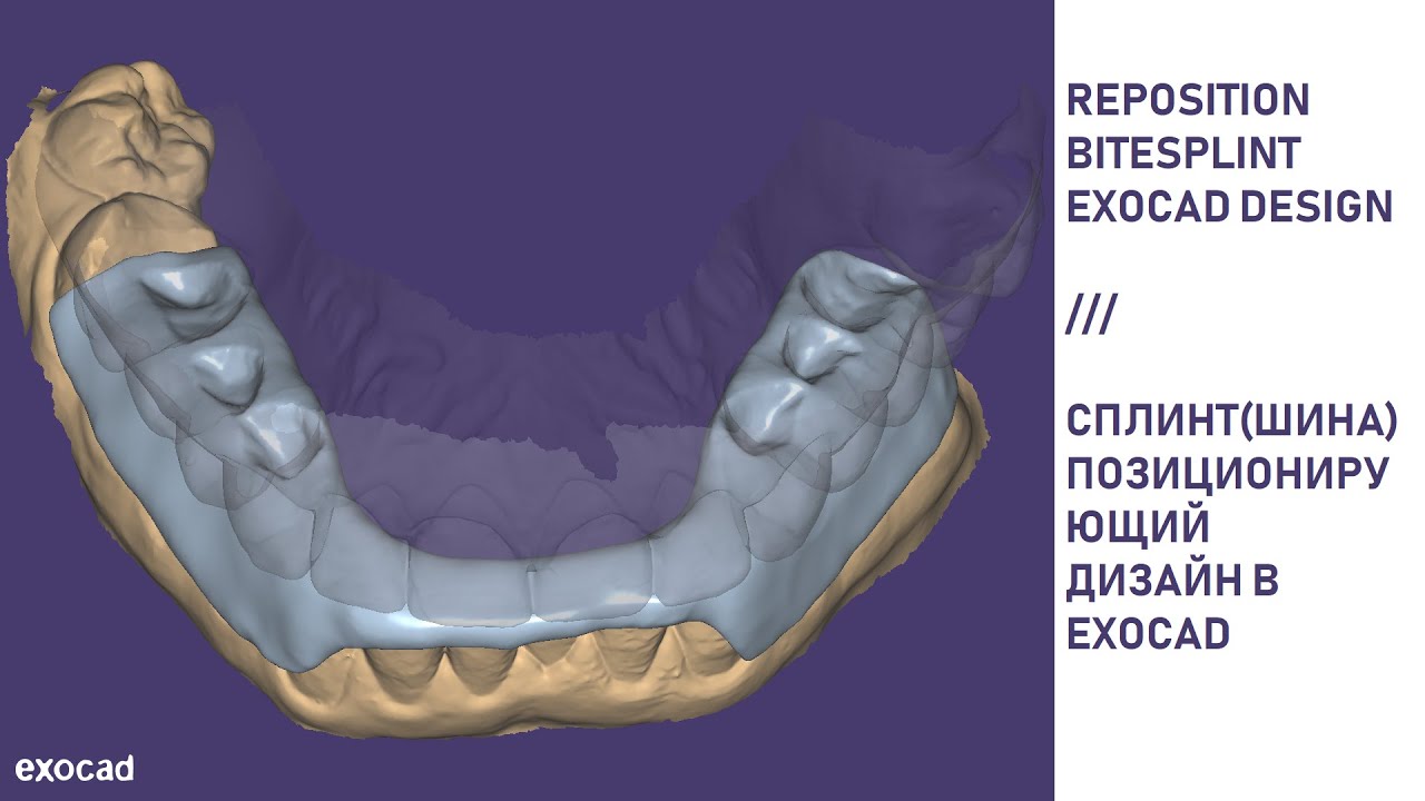 Дизайн позиционирующего сплинта в Exocad / Reposition bite splint design in Exocad
