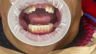 Wash Impression Technique for Removable Partial Denture