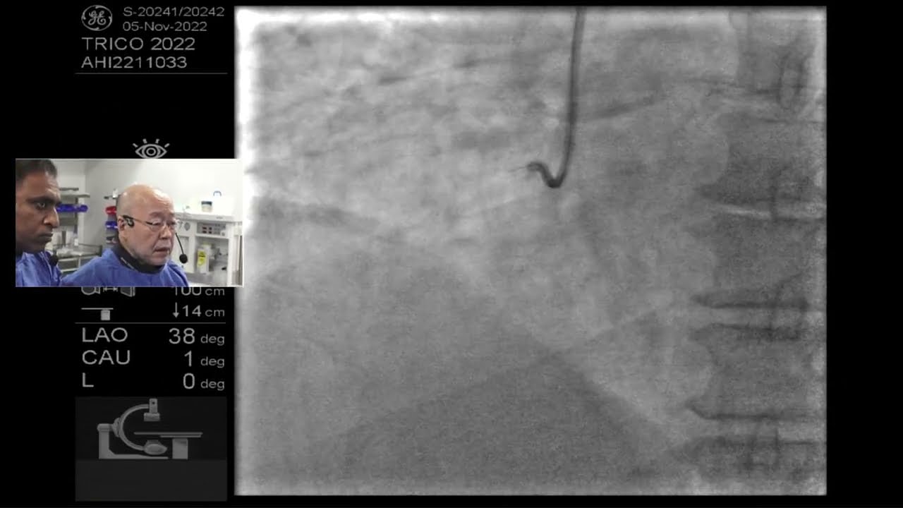 Complex CTO of RCA done by Dr. Shigeru Saito with Rajni