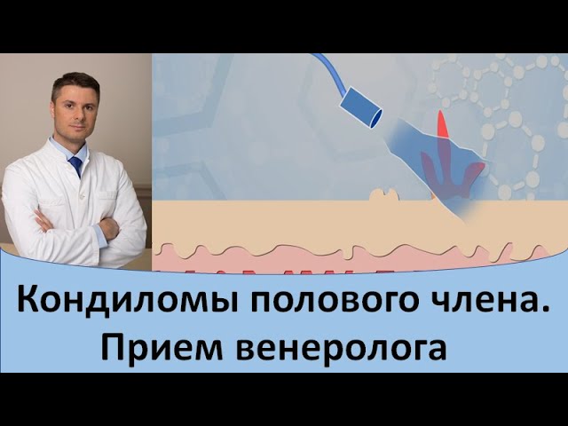 Кондиломы полового члена. Прием дерматовенеролога