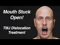 Mouth Stuck Open! TMJ Dislocation Treatment (Open Lockjaw)