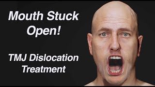Mouth Stuck Open! TMJ Dislocation Treatment (Open Lockjaw)