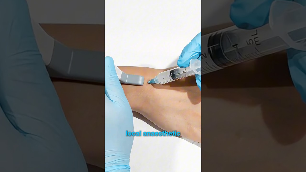 3/3 Методы лечения ганглиозных кист запястья