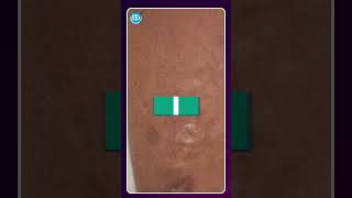 What is Vericose Veins? | India’s Best Varicose Veins Treatment || Dr. Rajah V. Koppala || iDream