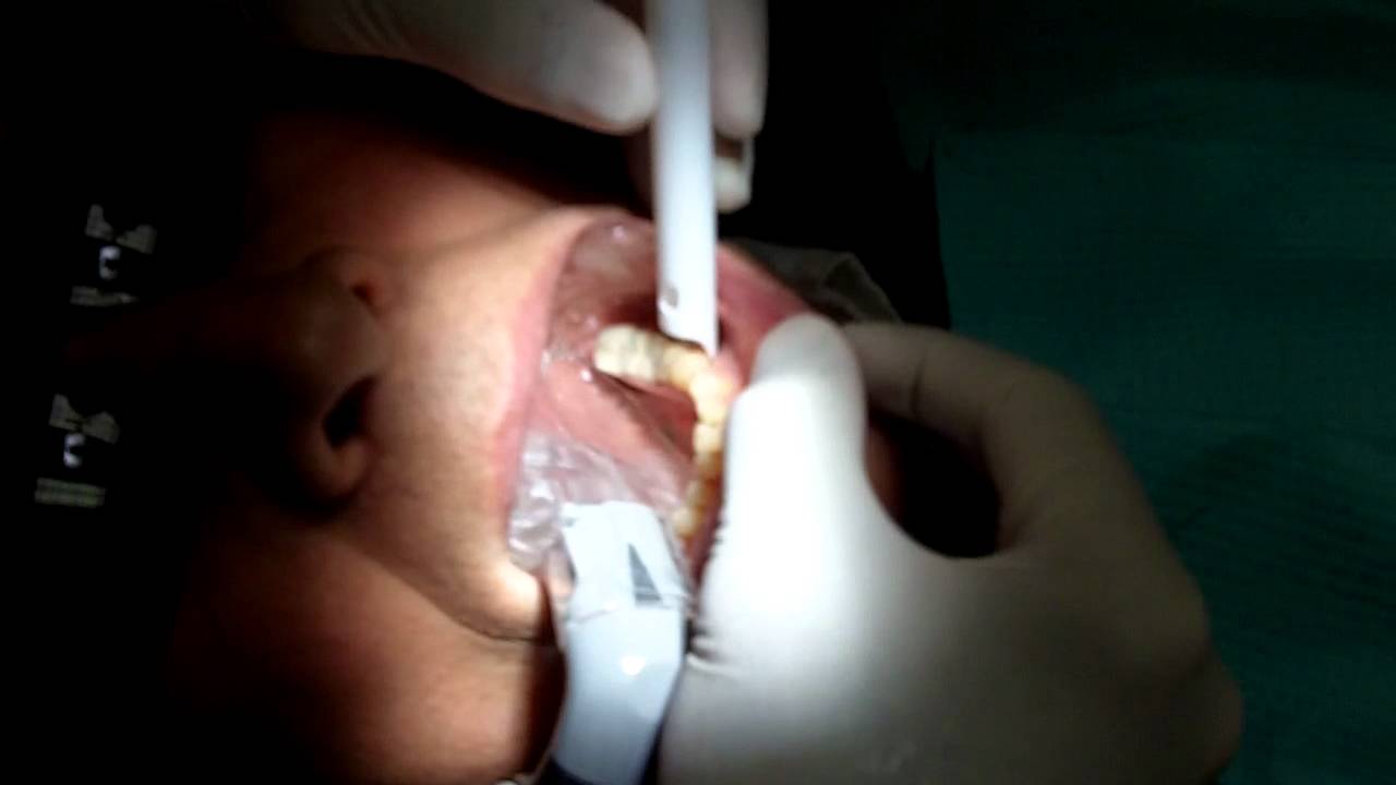 SafeVac HVE Dental Tips Ultimate Patient Safety and Comfort! YouTube