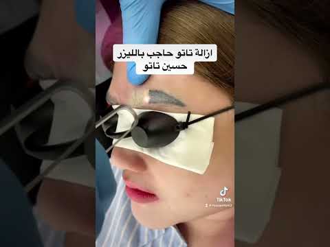 ازالة تاتو حاجب بالليزر بدون اثر