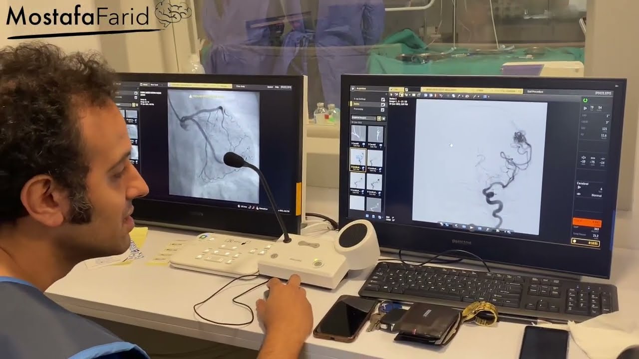 علاج تشوة شرياني وريدي بالمخ ( وحمة المخ ) عن طريق القسطرة المخيه باعلي درجات الامان