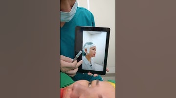 Kết quả nâng mũi cấu trúc Surgiform + cắt cánh mũi tại Dr. Chiều