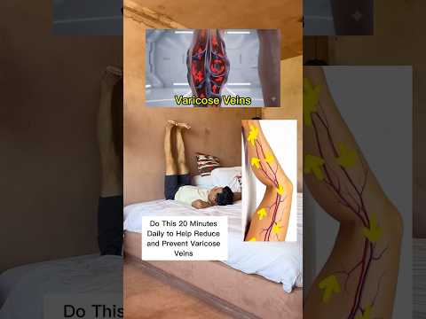 Varicose Veins Remedy!! ♥️😍 #varicoseveinstreatment  #exercise