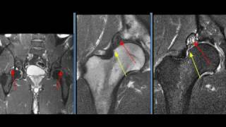MRI Hip Case 22 screenshot 4