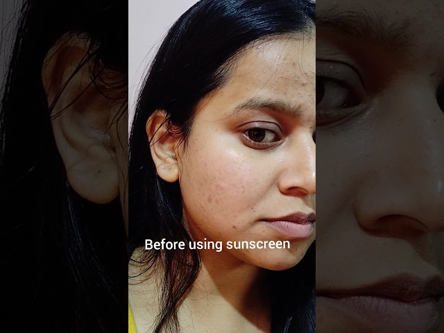 Before Vs After using sunscreen for a month #shorts #skincare #youtubeshorts #aqualogica class=