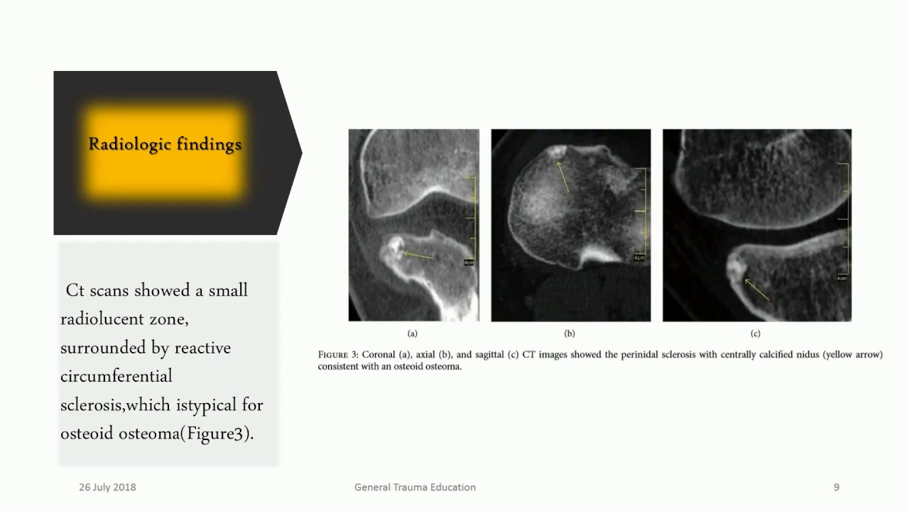 Intra Articular Osteoid Osteoma