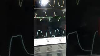 What's Auto triggerring?