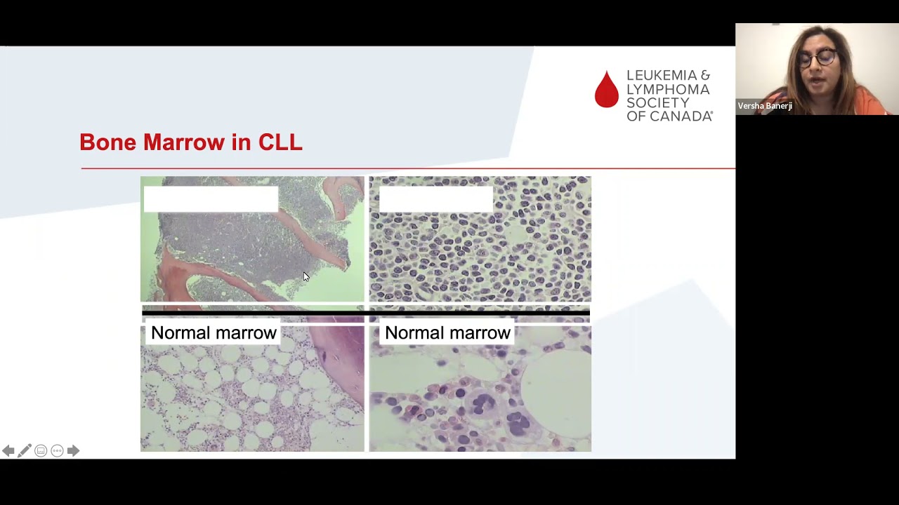 New frontiers and emerging treatments for CLL