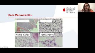 New frontiers and emerging treatments for CLL