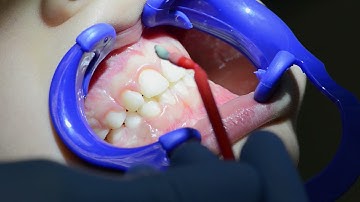 How to use FluoroDose from Centrix for decay protection