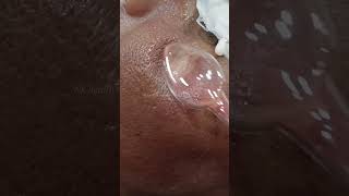 acne force treatment || high frequency acne treatment #acne #song #makeup #skincare #multistepcut