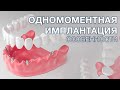 Одномоментная имплантация зубов. Какие особенности одномоментного протезирования?