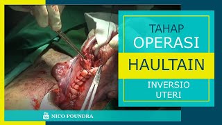 Tahapan Operasi Haultain untuk tata laksana inversio uteri