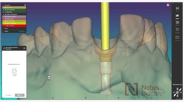 How to design your NobelProcera® Ti Abutment using exocad™