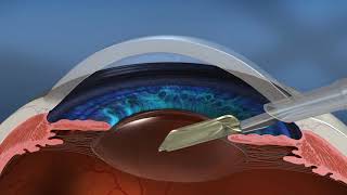 LenSx Patient Animation video
