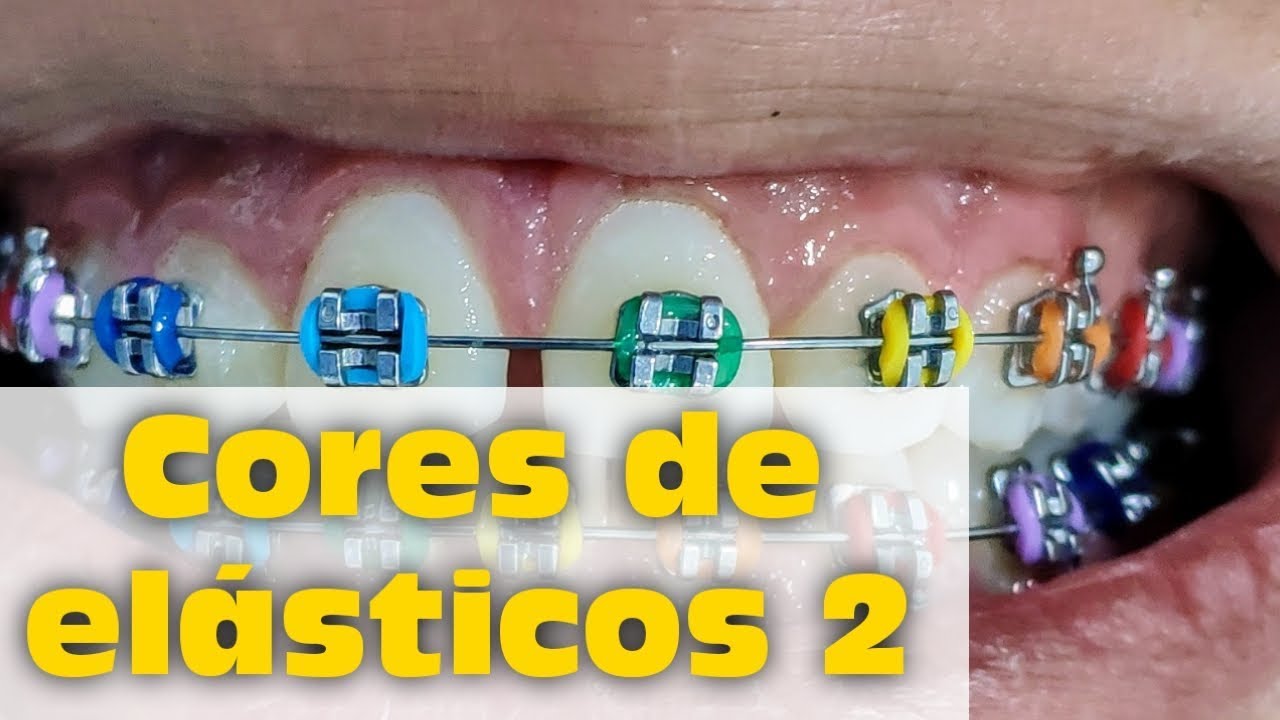 Cores de elásticos do aparelho parte 2