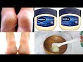 The Secret to treating Cracked Feet overnight