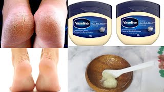 The Secret to treating Cracked Feet overnight