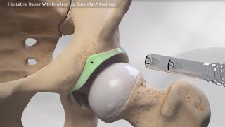Hip Labral Repair With Knotless Hip SutureTak® Anchors