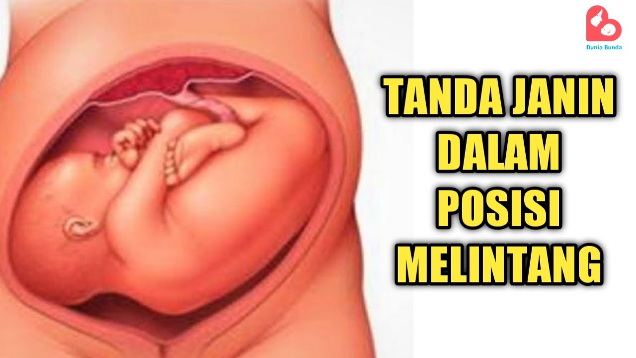 Waspada Ciri Ciri Janin Di Kandungan Dalam Posisi Melintang Youtube