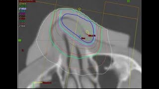 Part 1   Creating a Nose Bolus in Eclipse