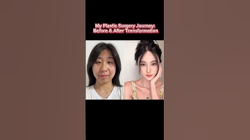 My Plastic Surgery Journey: Before & After Transformation #facetransformation #beautytransformed