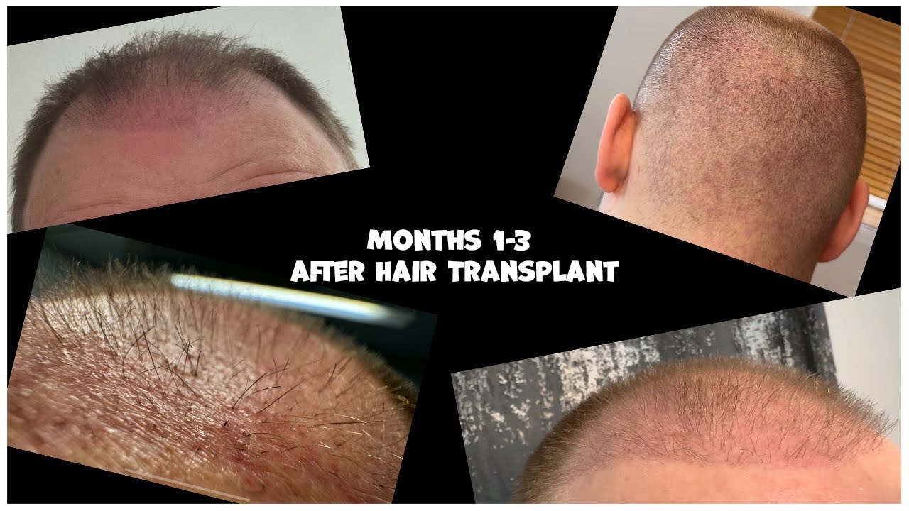 Hair Transplant 3 Month Results Update | First Hair cut - YouTube