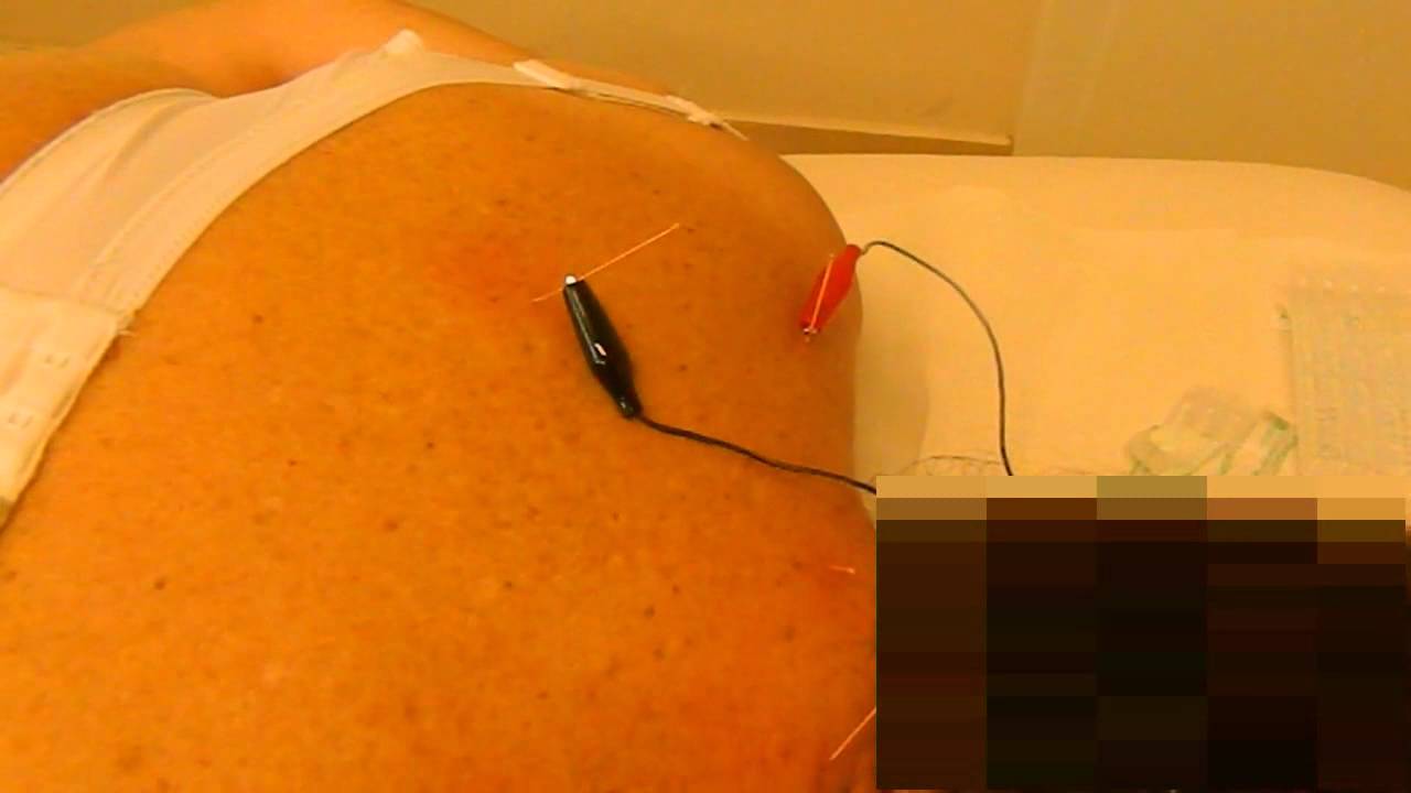 Needle electric intramuscular stimulation
