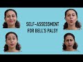 Assess your bell's palsy recovery by yourself.