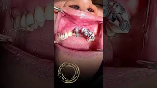 Immediate Loading Implants | Best Dental Implant Clinic in Hyderabad