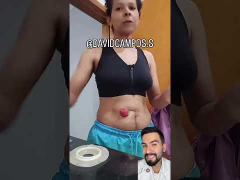 COLOSTOMÍA