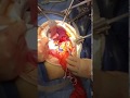 Large retro peritoneal tumor Removal - Before